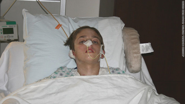 Hospital officials say Michael Brewer, 15, shown at a burn center, communicates only in one- or two-word answers.