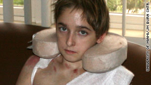 Michael Brewer was burned over 65 percent of his body in October.