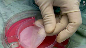 Lab created skin helps wounds heal CNN