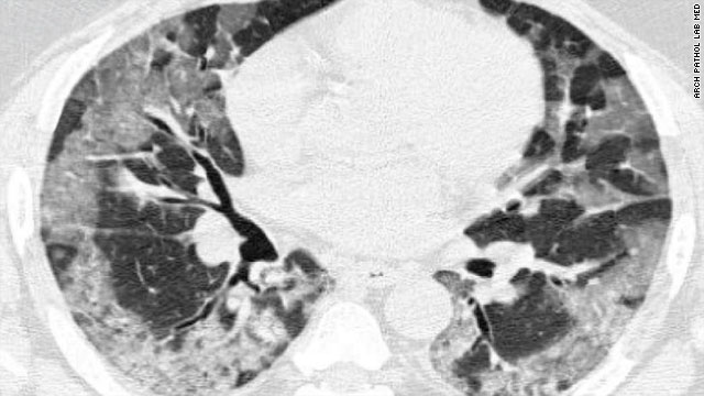 Damaged lung tissue is seen as light gray and healthy lung tissue is seen as dark gray in this cross-sectional CT scan of a deceased patient with pulmonary bacterial infection caused by the H1N1 virus. The other organs are white.