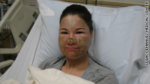 Bethany Storro says a pair of sunglasses that she had just bought prevented the acid from getting to her eyes.