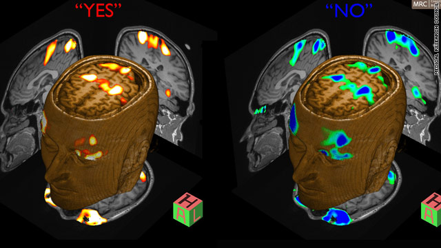 MRI scan shows different responses in the brain after the patient is asked different questions.