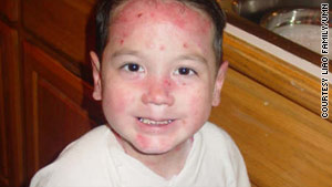 Eb Skin Disorder