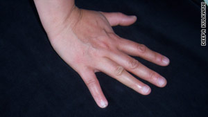 Kulkarni's pinky grew back after she persuaded a doctor to administer a procedure she had read about on the internet.