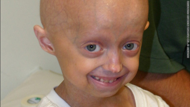 Progeria Symptoms | Cancer Revisited