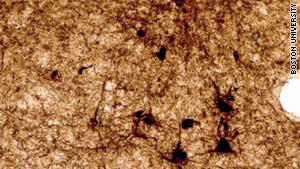 Microscopic images show large numbers of tau (dark brown spots) in the areas of damage.  In healthy brain tissue, there would be no such protein tangles.