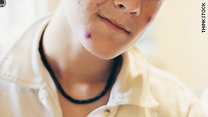 Teens with bad acne are at a greater risk of having suicidal thoughts than their peers.