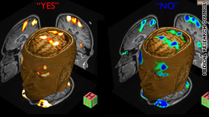 Magnetic mind scan proved my brain was alive