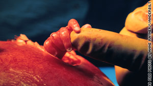During surgery on a 22-week-old fetus at Vanderbilt, Dr. Joseph Bruner demonstrates size by comparing the fetus' hand to his index fingertip.