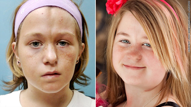 When Christine Honeycutt was five years old, one side of her face seemed to mysteriously stop growing.