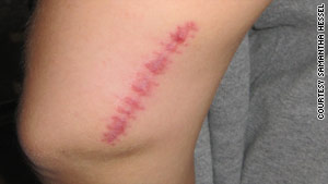 The scar on Samantha Hessel's left arm from surgery to remove a cancerous mole.