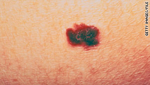 This is a detail shot of a malignant melanoma tumor. Melanoma is the deadliest form of skin cancer.