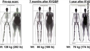 This dexa scan of a woman who underwent bariatric surgery shows where she lost her body fat.