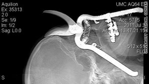 This CT scan shows the handle of garden shears lodged in Leroy Leutscher's skull.