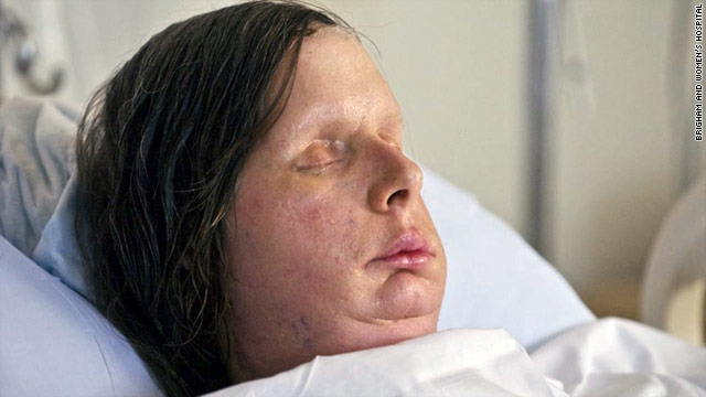 face transplant after chimpanzee attack