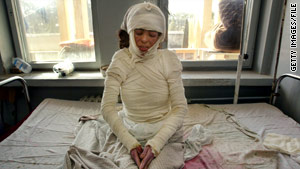 A 22-year-old woman, severely burned from self-immolation, sits on her hospital bed in Herat, Afghanistan, in 2004.