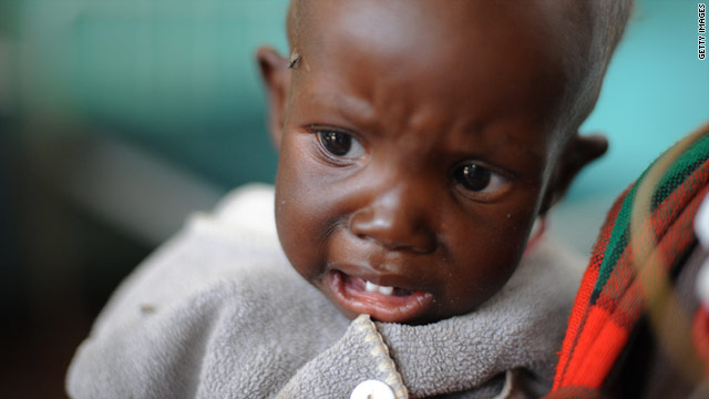 Malnourished Gloria Akae is being treated at Lodwar Hospital,  Kenya.
