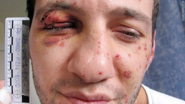 Danish police photograph shows Lors Doukaev with the scars he sustained when he set off a bomb.