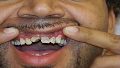 Gold 'grill' ripped from mouth