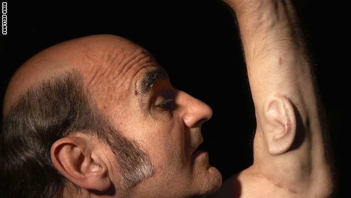 إلى أين تصل حدود الفن؟ رجل يزرع أذناً ثالثة بذراعه