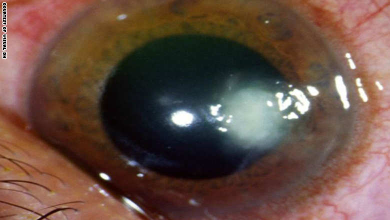 هذا الموقع الإلكتروني يعرف ما لا يعرفه الأطباء 150520132320-funal-eye-ulcer-exlarge-169