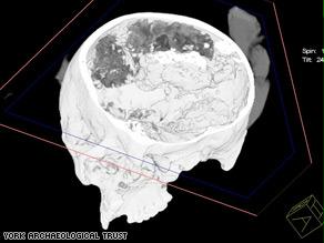 عثر على نسيج حي داخل الدماغ.. ومادة بيولوجية صفراء