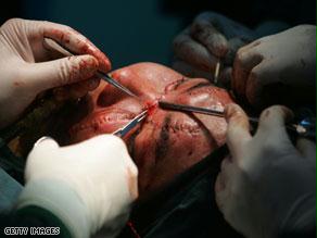 أجريت جراحة زراعة وجه واحدة في الصين