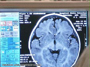 الأشعة عبر الرنين المغناطيسي قد تظهر أسباب التلف في الدماغ الذي يؤدي للألزهايمر 
