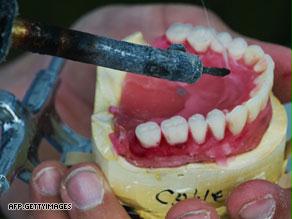 تأثر طبقة المينا التي تحمي الأسنان يؤدي إلى ت’كل الأسنان