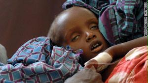 طفل صومالي أعياه الجوع والمرض
