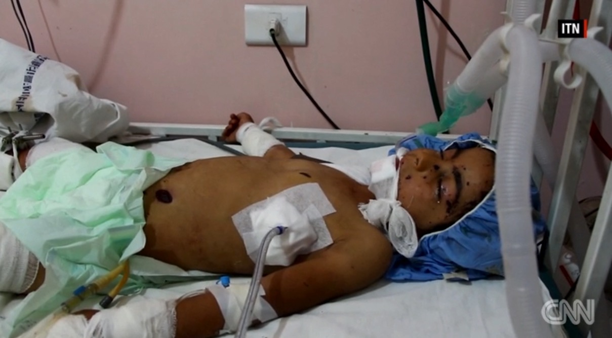 طفلة تلتقط لعبة في شوارع حلب.. وإذ بها قنبلة عنقودية انفجرت بين يديها