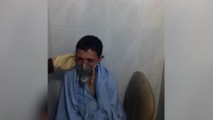 “هل سأموت؟”.. طفل سوري يعاني بعد قصف كيماوي محتمل
