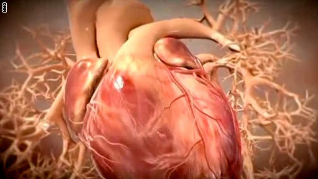 ما هي أمراض القلب وكيف تؤثر على الجسم؟ 110818102853-graphic-heart-attack-super-tease