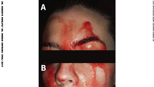 هذه المرأة تتعرق دماً من وجهها ويديها 171023181928-01-sweating-blood-case-study-exlarge-169