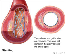 stent.03.jpg